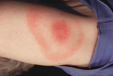 Apró csípés, nagy probléma – a Lyme-kór tünetei, diagnózisa