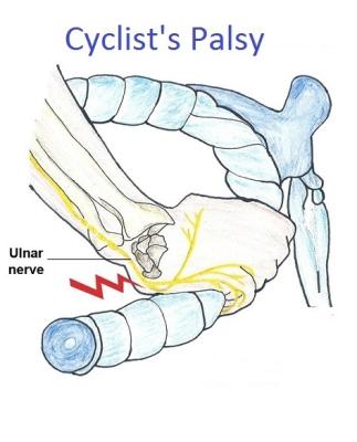 iliacus alagút szindróma ujj falának ízületi gyulladása